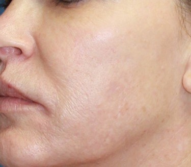 After DermaSweep