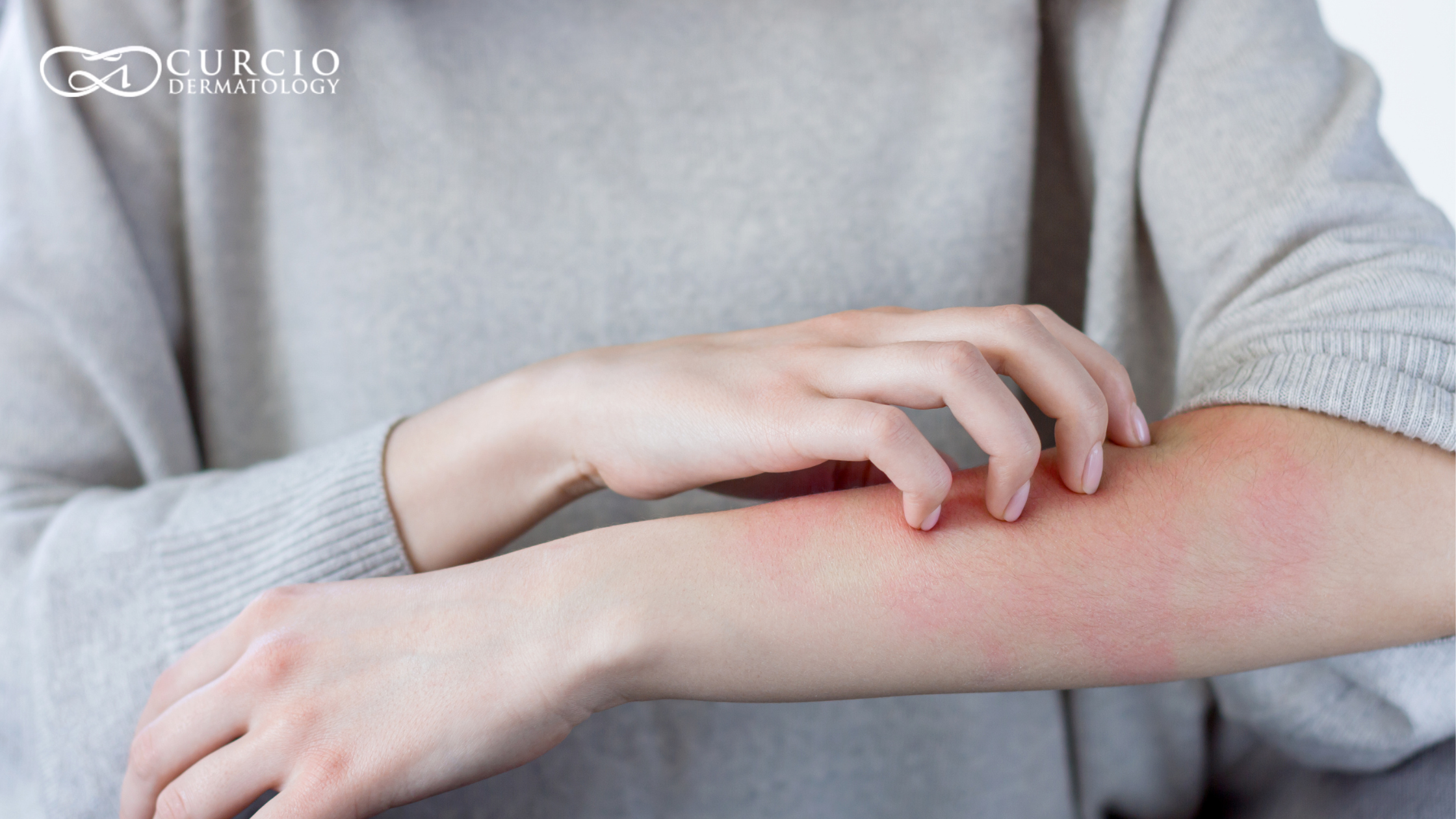 Eczema Skin Care Tips