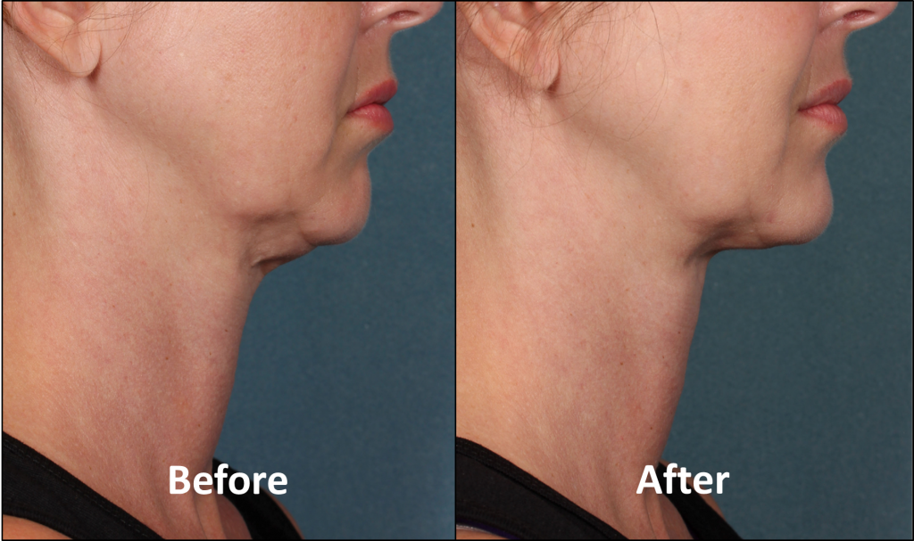 Kybella in Nashville | Double Chin Treatment | Curcio Dermatology