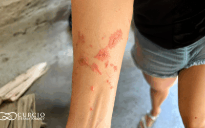 Why Poison Ivy / Poison Oak Reactions Are So Common in Tennessee’s Humid Climate