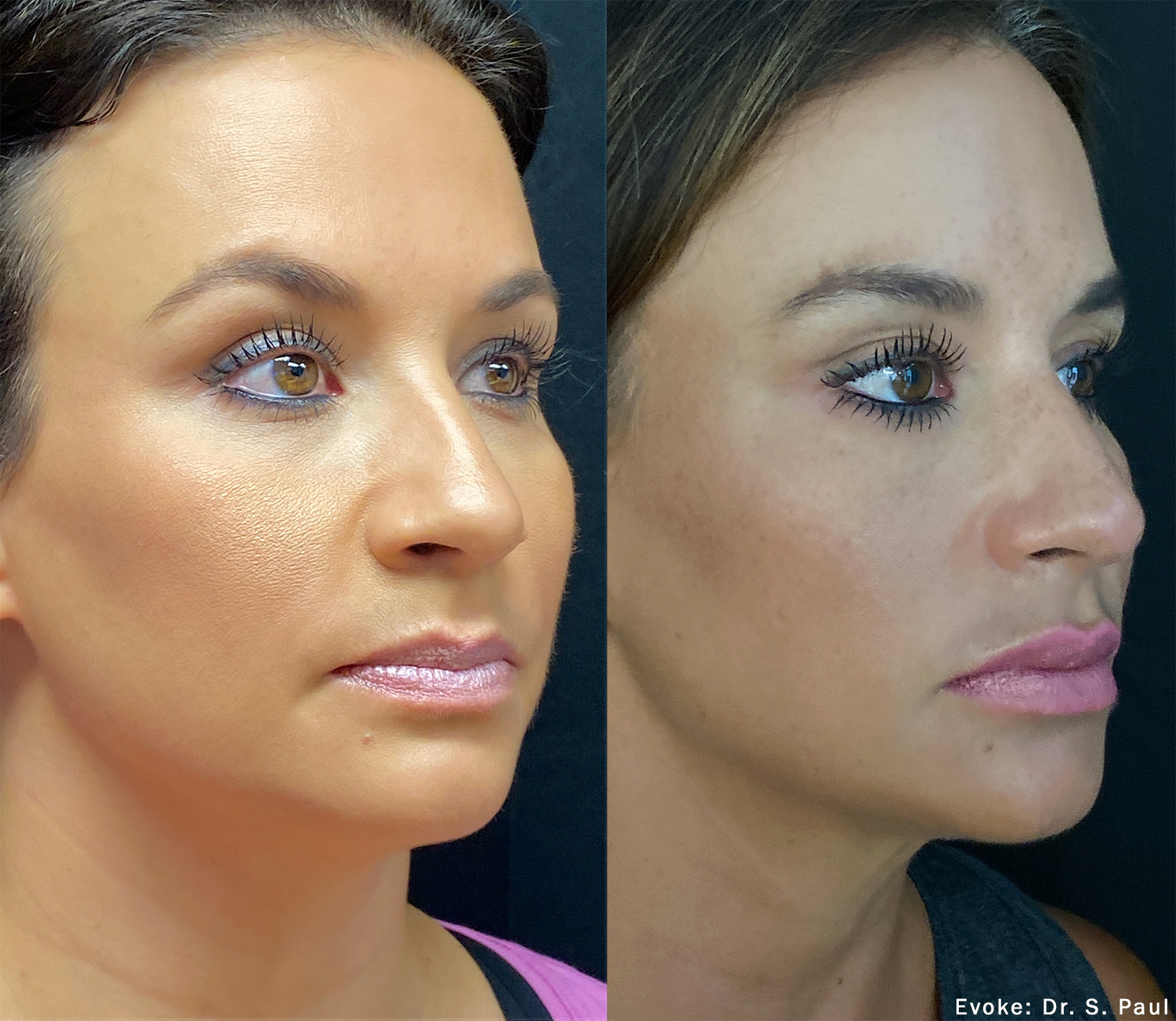 Evoke – Customizable Facial and Neck Remodeling Maintenance 3 Treatment Package