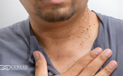 Skin Tag Removal in Nashville, TN – What to Expect