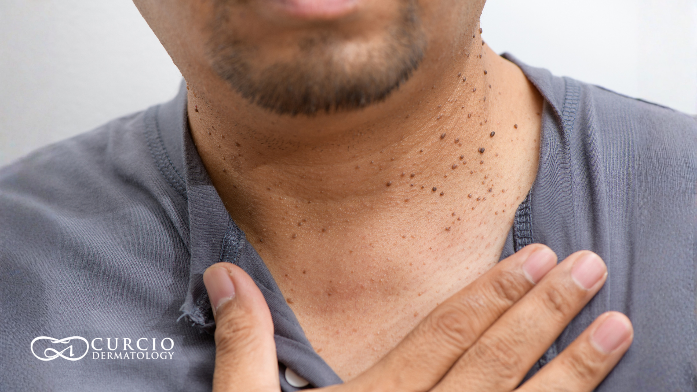 Skin Tag Removal in Nashville (1)