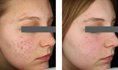 Acne Scars Treated with Laser Genesis