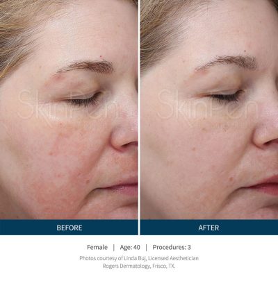 SkinPen® Microneedling