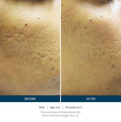 b-a-slide23-1-2-1-800x810-2-400x405 SkinPen® Microneedling