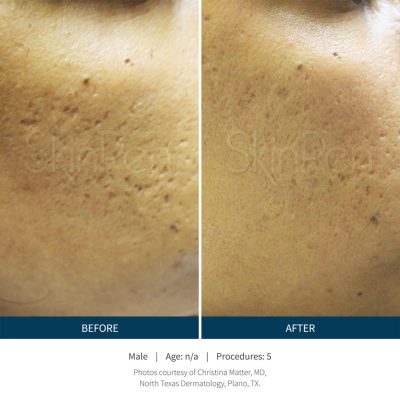 SkinPen® Microneedling