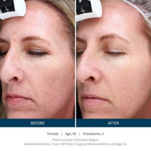 SkinPen® Microneedling