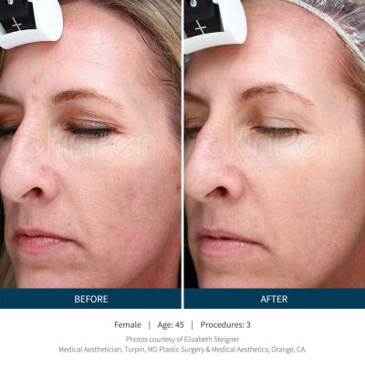 SkinPen: Package of 3 Treatments ($999) for $799 – Must purchase by Jan 31, 2023