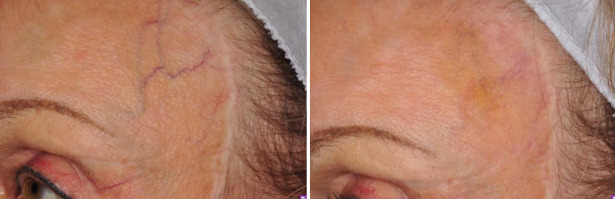 forehead veins before after