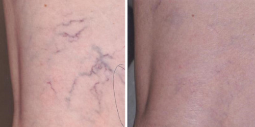 leg veins before after