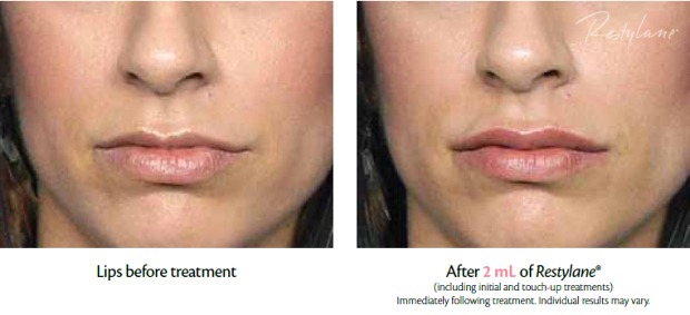 Restylane® Lip Before After