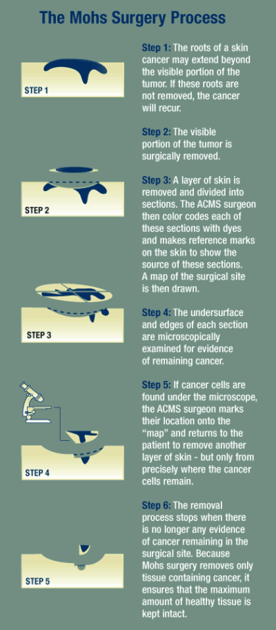 Mohs Process