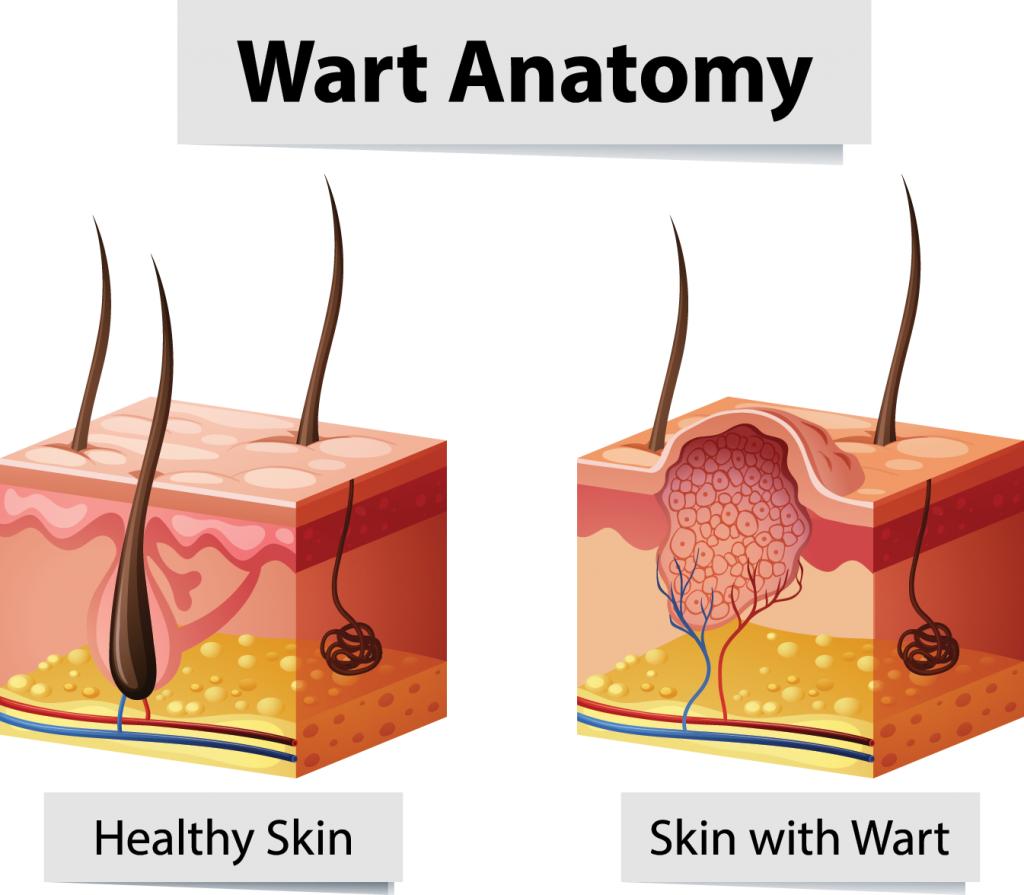 Wart Removal in Nashville Tennessee - Curcio Dermatology
