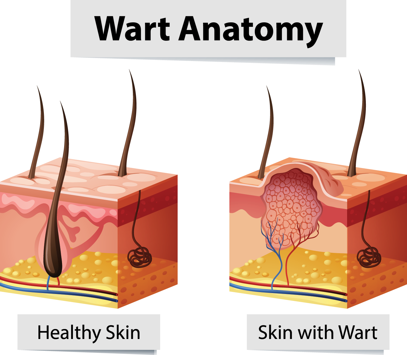 Wart Removal Nashville TN